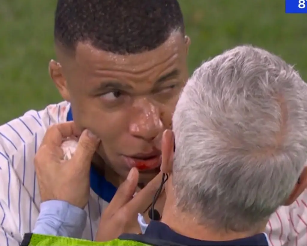 Kylian Mbappé et son nez fracturé